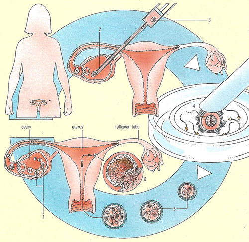 in-vitro fertilization