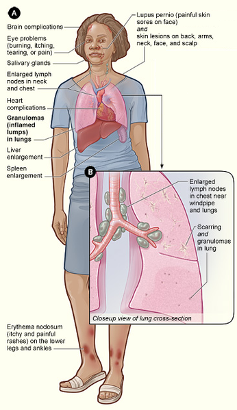 sarcoidosis signs and symptomse