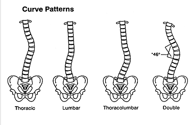 Types of curvature in scoliosis