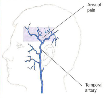 temporal arteritis