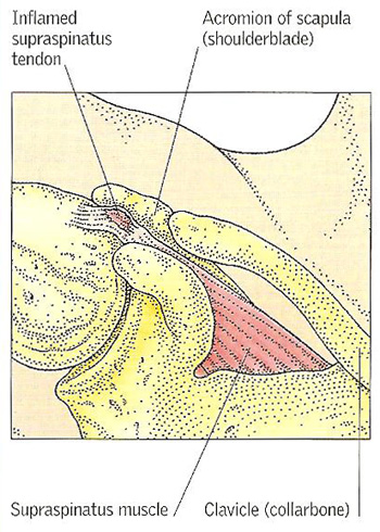tendinitis in the shoulder