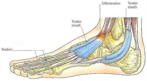 tenosynovitis