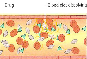 Thrombolytic drug in action