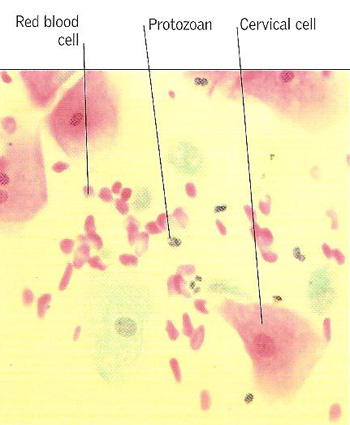 Magnified image of cells from the cervix shows the presence of Trichomonialis vaginalis, the protozoan responsible for trichomonialis