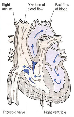 tricuspid incompetence