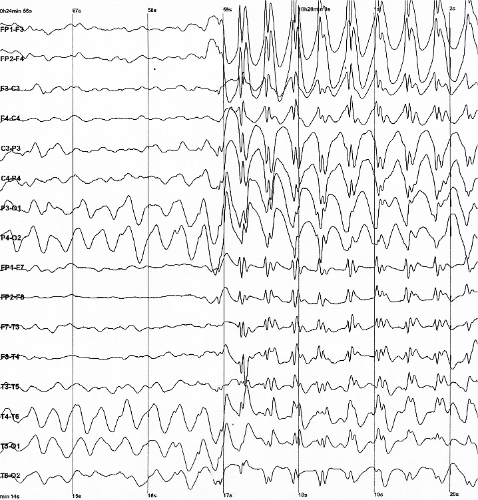 Spike-waves, recorded by an electroencephalograph, during an epileptic seizure.