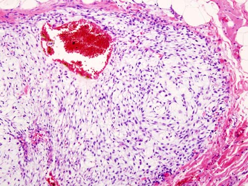 Histopathogic image of chondrosarcoma of the chest wall.