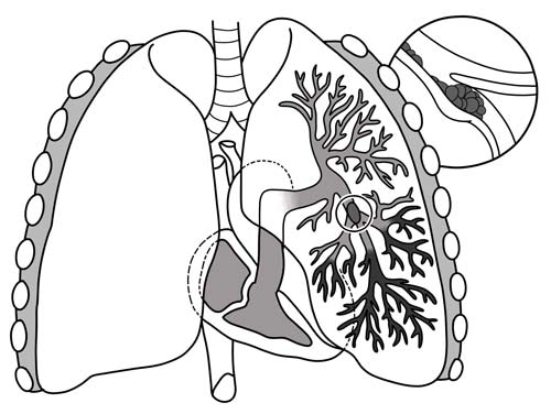 Pulmonary embolism