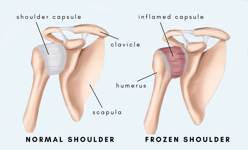 Normal shoulder and frozen shoulder