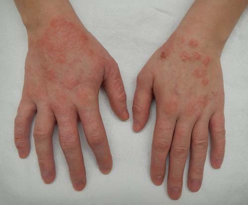 Dermatitis of the hands.