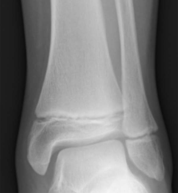Radiogram of distal tibia (left) and fibula (right) showing two growth (epiphyseal) plates.