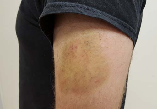 A contusion (bruise), a simple form of hematoma.
