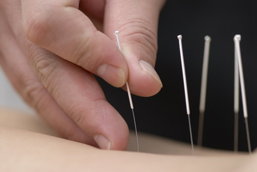 acupuncture needles being applied