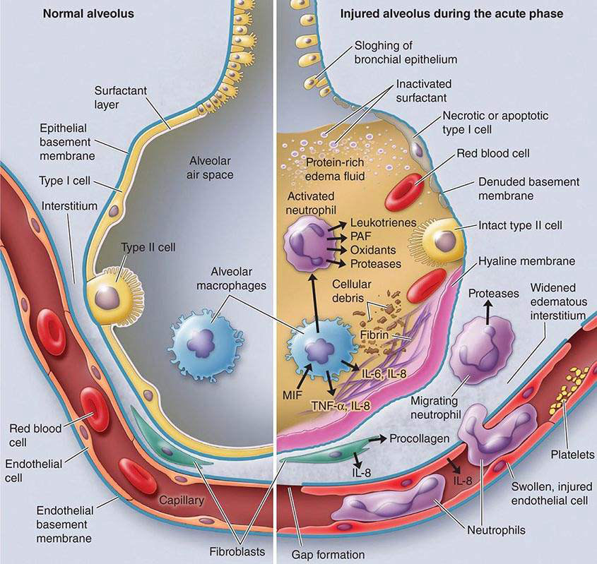 acute respiratory distress syndrome