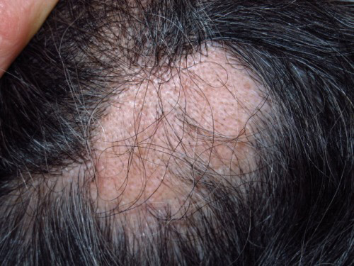 alopecia areata