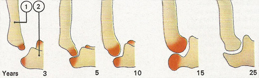 bone growth