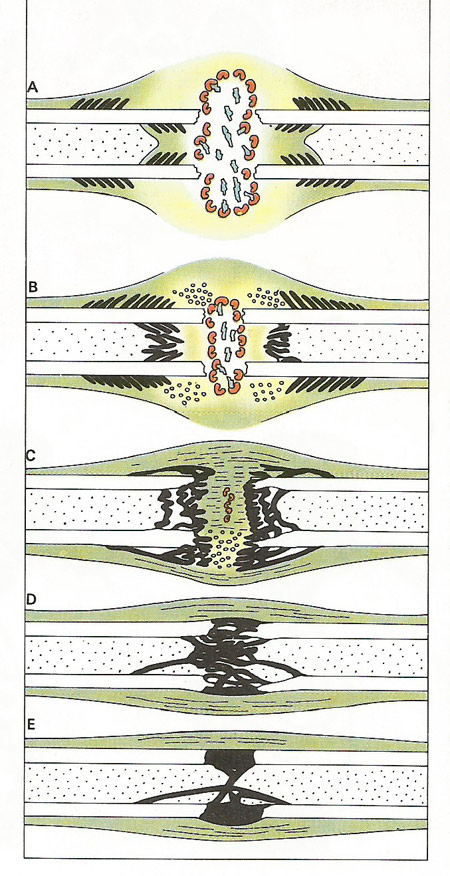 stages in healing of a fracture