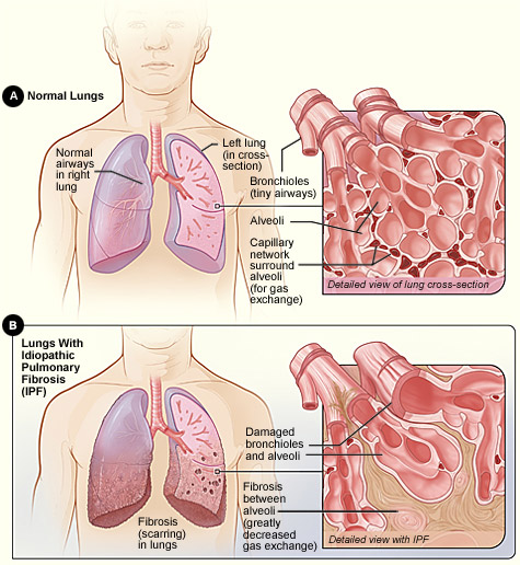 idiopathic pulmonary fibrosis