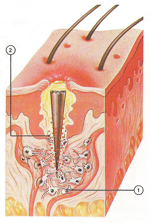 leukocytes fighting infection