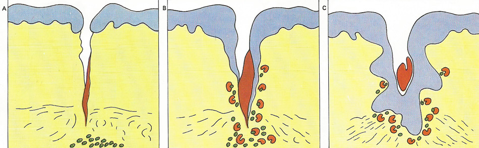 wound healing