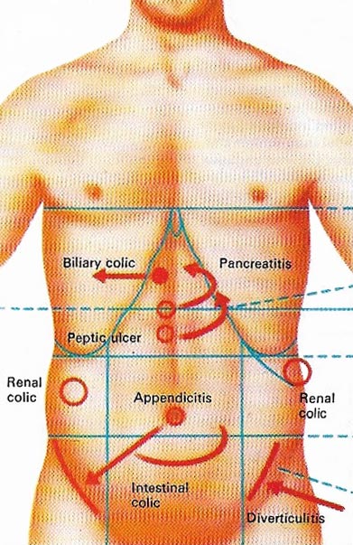 acute abdomen