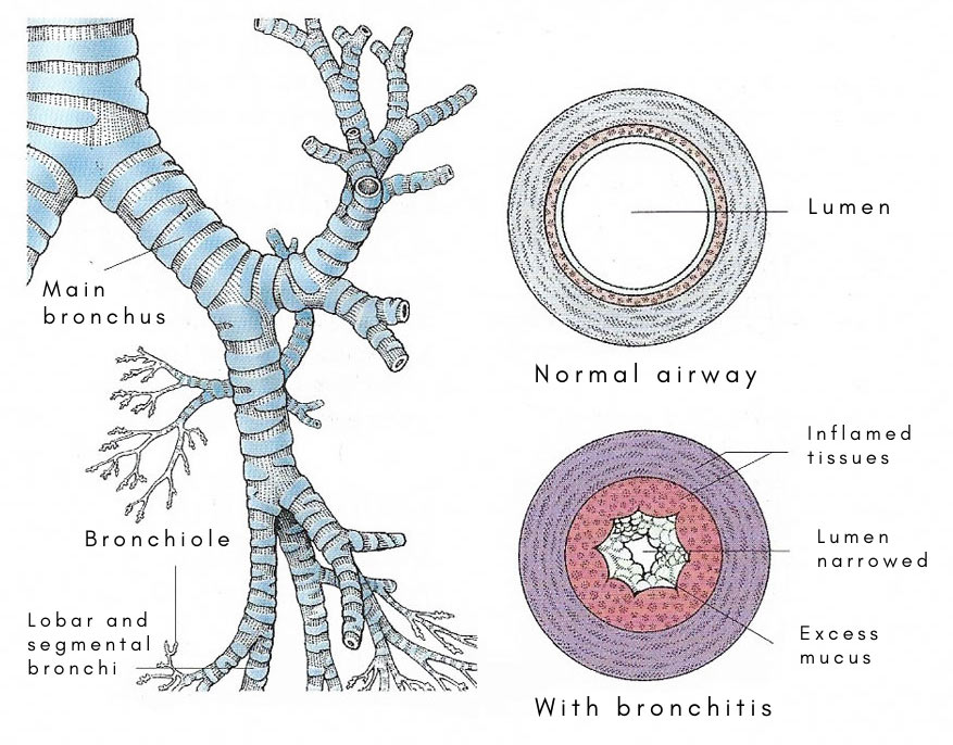 Acute bronchitis