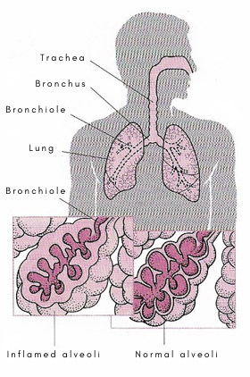 effects of alveolitis