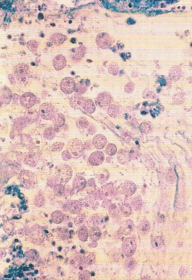 Light micrograph of Entamoeba histolytica, which causes the infection amoebiasis, showing amoebae (blue) invading the lining of the colon