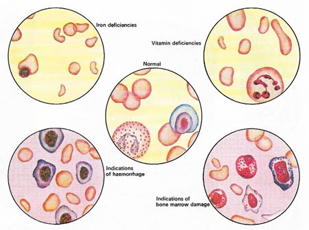 anemia