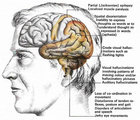 brain damage disorders