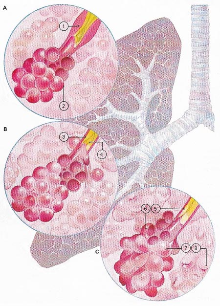 disease of the airways