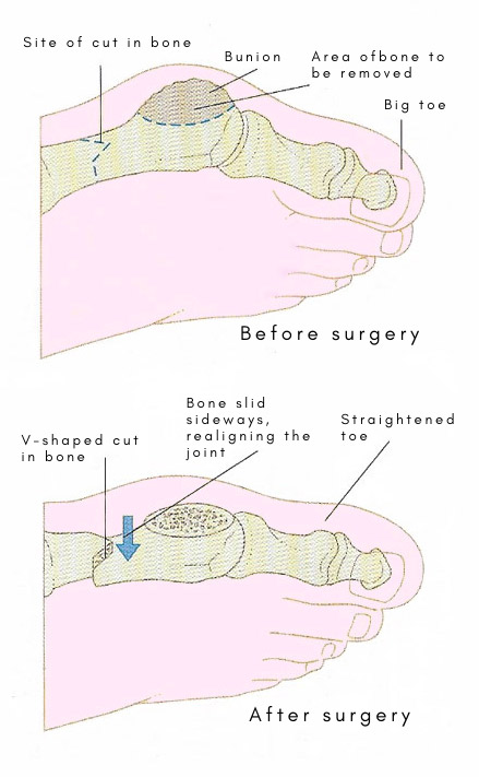 bunion surgery