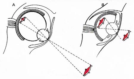 comparison of vertebrate and cephalopod eye