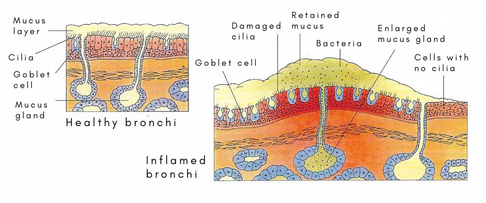 Chronic bronchitis