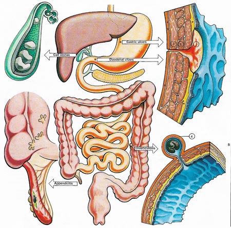 disorders of the digestive tract