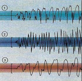 epileptic seizure brain waves