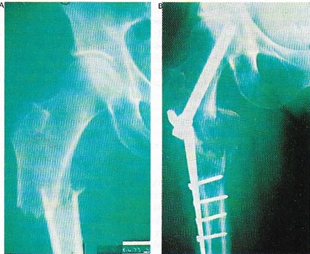 fracture of the femur