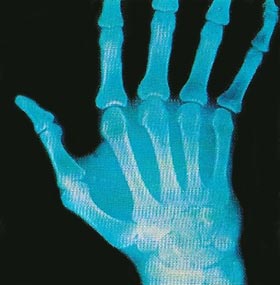 rheumatoid arthritis in the hand