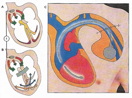 the heart's natural pacemaker