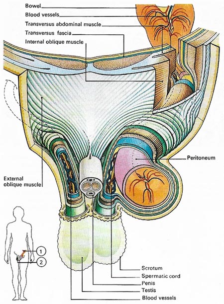 hernia