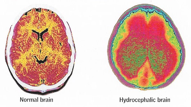 hydrocephalus