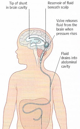 shunt for hydrocephalus