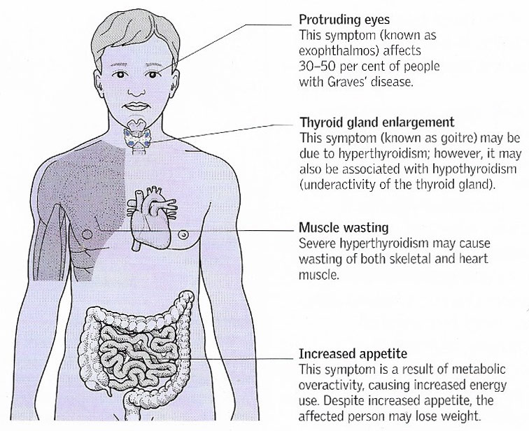 Hyperthyroidism