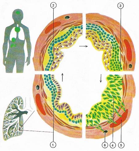 lung cancer