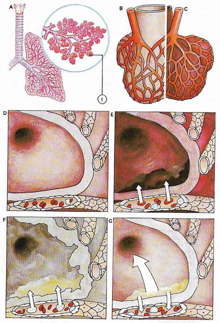 pneumonia