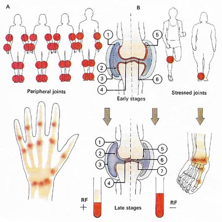 rheumatism