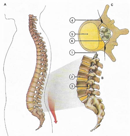 slipped disc