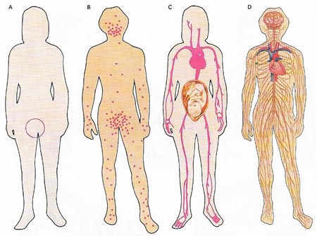 syphilis