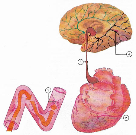 thrombosis