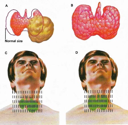 thyroid disorders
